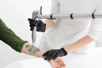 Tattoo Removal Technology