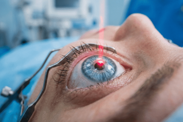 Laser Eye Surgeries