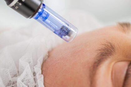 Optimal Microneedling Aftercare