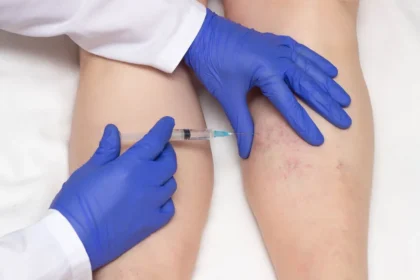 Vein Treatment