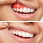 Maintaining Gum Health