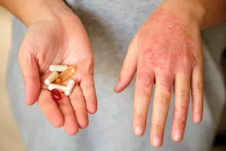 Research on Drug Allergies
