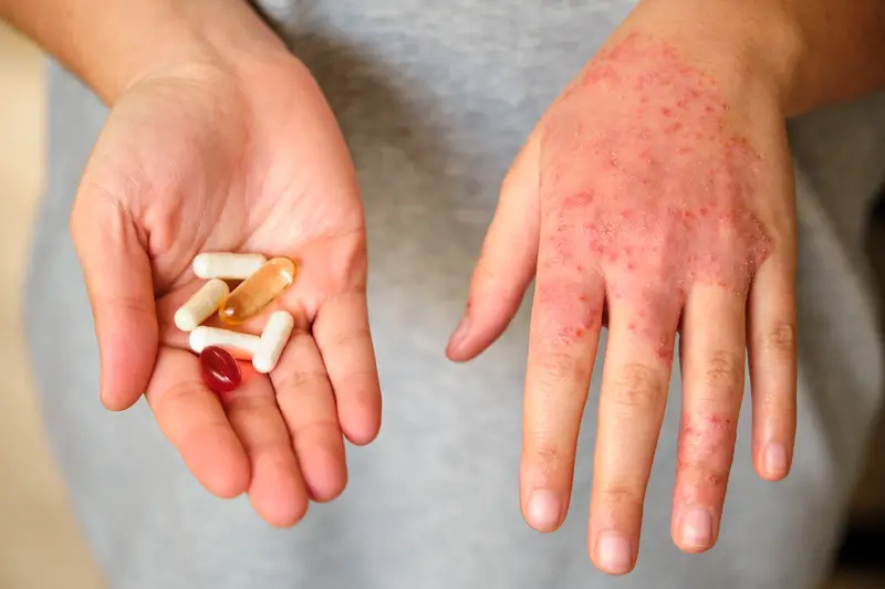 Research on Drug Allergies